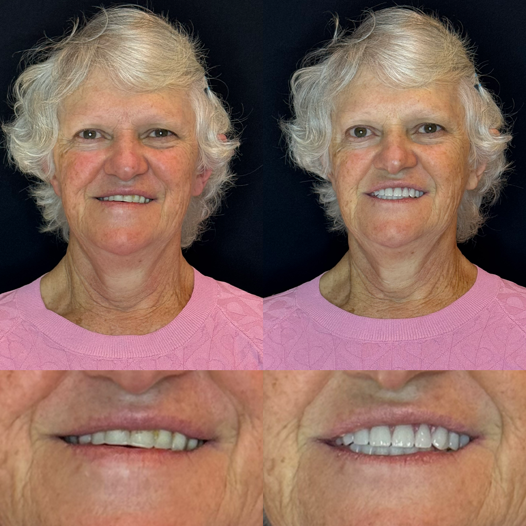 Antes e Depois - 01