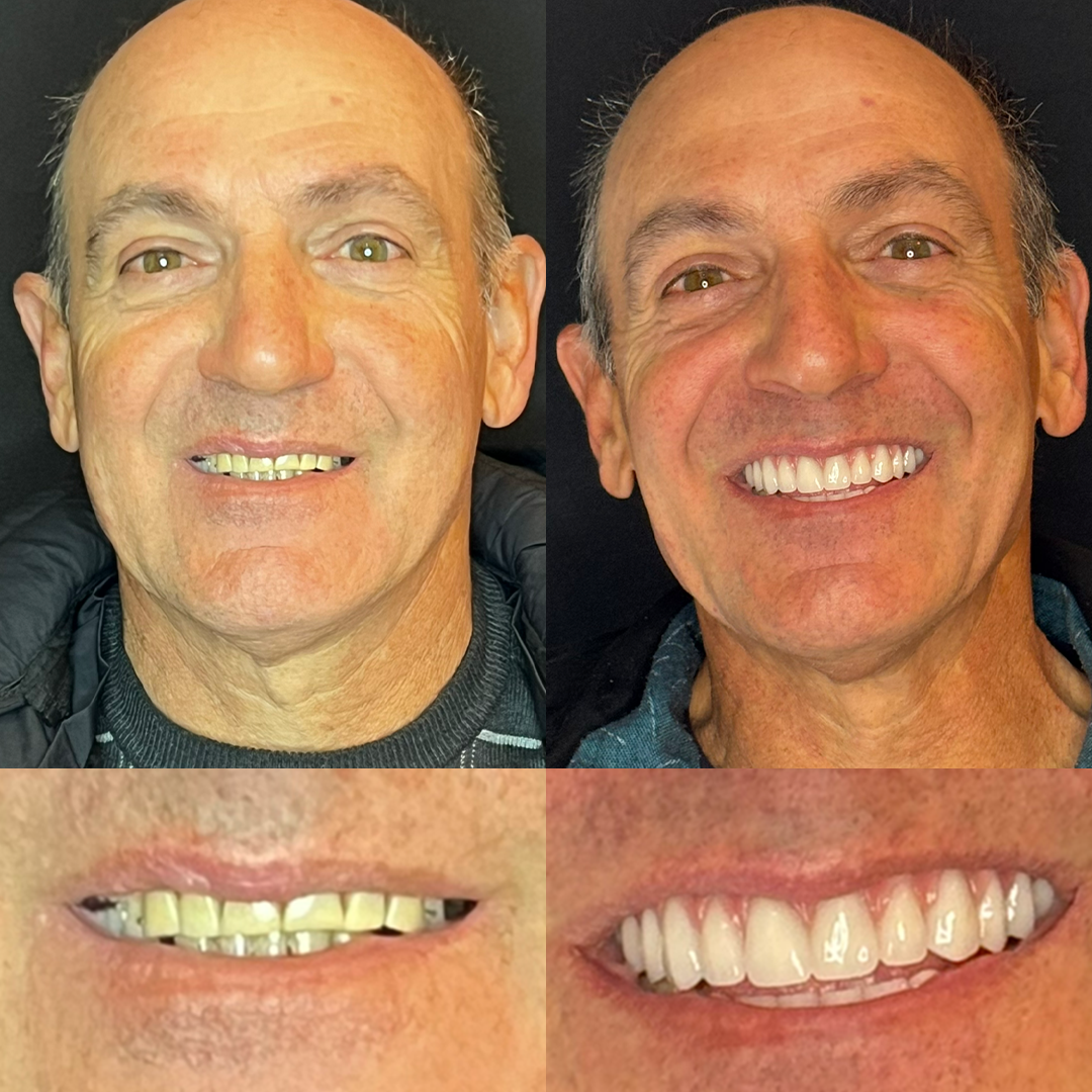 Antes e Depois - 02