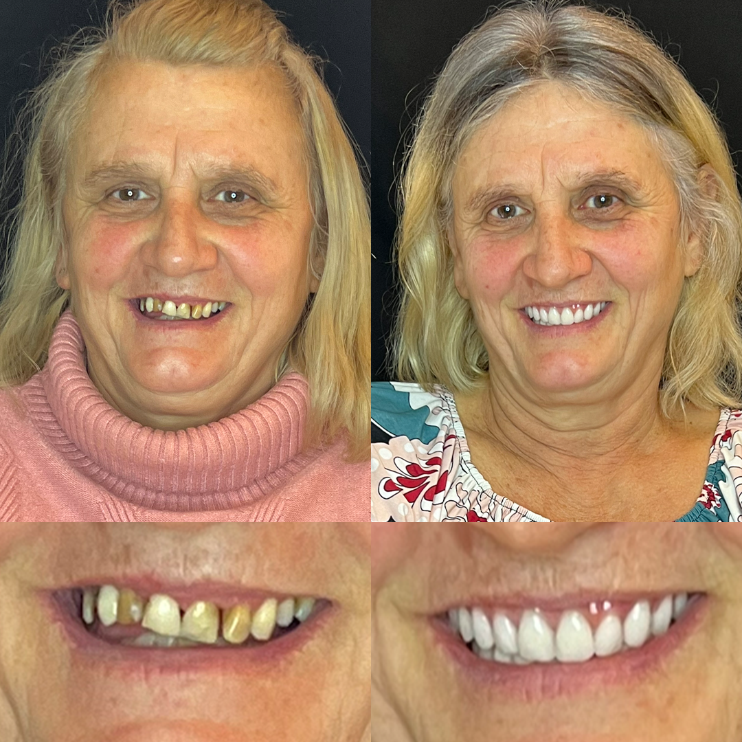 Antes e Depois - 03