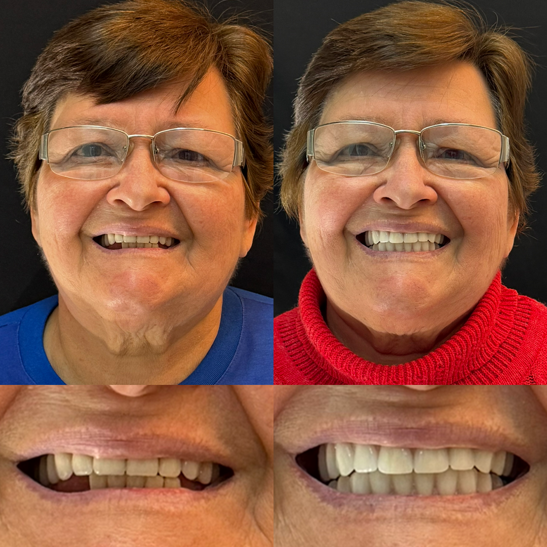 Antes e Depois - 04